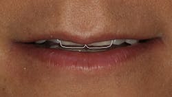 Figure 1: Repose photo showing proposed incisal edge position Figure 1: Repose photo showing proposed incisal edge position