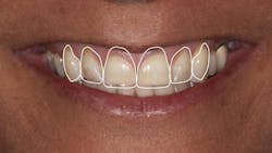 Figure 2: 2D outline of proposed anterior tooth position Figure 2: 2D outline of proposed anterior tooth position