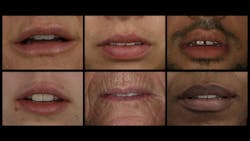 Figure 3: Significant variations exist in lip size and shape, as well as incisal display. Figure 3: Significant variations exist in lip size and shape, as well as incisal display.