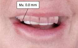 Figure 4: Superimposed smile and repose photos showing canine cusp tip coinciding with edge of upper lip Figure 4: Superimposed smile and repose photos showing canine cusp tip coinciding with edge of upper lip