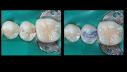 dental restoration dental restoration