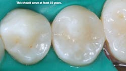 dental restoration dental restoration