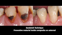 Figure 4: The well-known “sandwich technique” has glass ionomer (Equia Forte–Ketac Universal) internally with a typical composite placed over it. Figure 4: The well-known “sandwich technique” has glass ionomer (Equia Forte–Ketac Universal) internally with a typical composite placed over it.