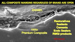 Figure 5: Note the wide-open margins of any brand of composite, allowing easy release of fluoride ions to form fluorapatite on the margins of the prep. Figure 5: Note the wide-open margins of any brand of composite, allowing easy release of fluoride ions to form fluorapatite on the margins of the prep.