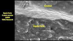 Figure 6: Note the seal offered by chemical chelation of the glass ionomer (Equia Forte–Ketac Universal) to the tooth prep surface. No other restorative material has this type of chelation. Figure 6: Note the seal offered by chemical chelation of the glass ionomer (Equia Forte–Ketac Universal) to the tooth prep surface. No other restorative material has this type of chelation.