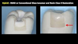 dental restoration dental restoration