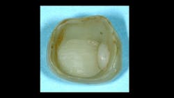Figure 8: A zirconia crown that came off in service in a CR study after only six months shows internal stain and release of the “bond” of the filler placed in a void. Figure 8: A zirconia crown that came off in service in a CR study after only six months shows internal stain and release of the “bond” of the filler placed in a void.