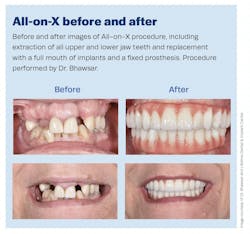 before and after photos of teeth before and after photos of teeth