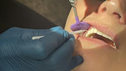 placing silver diamine fluoride on a dental patient placing silver diamine fluoride on a dental patient