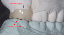 zirconia crown zirconia crown