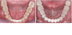 zirconia crowns and fixed prostheses zirconia crowns and fixed prostheses