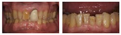 Figure 1: Severe wear on opposing teeth resulting from surface glazed maxillary PFM. Figure 1: Severe wear on opposing teeth resulting from surface glazed maxillary PFM.