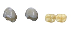 Figure 3: Left to right: a) Polished monolithic zirconia versus b) surface-glazed zirconia; c-d) Polished zirconia (left) next to an adjusted glazed zirconia crown (right). Figure 3: Left to right: a) Polished monolithic zirconia versus b) surface-glazed zirconia; c-d) Polished zirconia (left) next to an adjusted glazed zirconia crown (right).