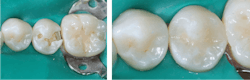 Figures 2 and 3: Initial caries should be restored when they are in the enamel to allow long-term service potential. Waiting longer until initial lesions have become large and deep compromises tooth strength, occlusion, and increases the potential for root canal treatment or worse. Figures 2 and 3: Initial caries should be restored when they are in the enamel to allow long-term service potential. Waiting longer until initial lesions have become large and deep compromises tooth strength, occlusion, and increases the potential for root canal treatment or worse.