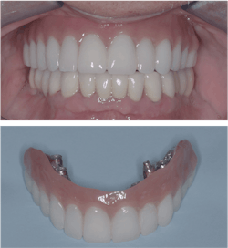 Figures 4 and 5: These patients would not have needed to spend thousands of dollars on preventable restorations if they had heeded dental professionals’ instructions about preventive dentistry. Figures 4 and 5: These patients would not have needed to spend thousands of dollars on preventable restorations if they had heeded dental professionals’ instructions about preventive dentistry.