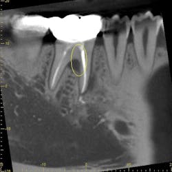 Figure 1: Before treatment with collagen, PRF, and exosomes Figure 1: Before treatment with collagen, PRF, and exosomes