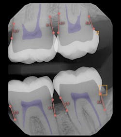 Figure 3: AI interpretation of a bitewing x-ray, Overjet.ai. Photo courtesy of Salem Dental Arts Figure 3: AI interpretation of a bitewing x-ray, Overjet.ai. Photo courtesy of Salem Dental Arts