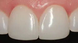 After Post-Op Direct Veneers using OMNICHROMA (Tokuyama Dental America)