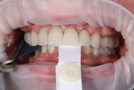 Figure 21: CR occlusion with final restorations Figure 21: CR occlusion with final restorations