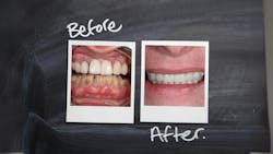 Two polaroid photos showing a dental case before and after treatment Two polaroid photos showing a dental case before and after treatment