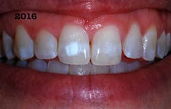 Figure 1: White dysmineralization defect was of cosmetic concern to this woman in her early 30s. Figure 1: White dysmineralization defect was of cosmetic concern to this woman in her early 30s.