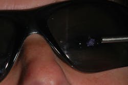 Figure 3: Demonstration of why eyeglasses are essential for the patient Figure 3: Demonstration of why eyeglasses are essential for the patient