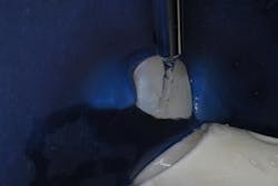 Figure 4: Periodic water rinsing allows for evaluation of white spot removal. Figure 4: Periodic water rinsing allows for evaluation of white spot removal.