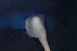 Figure 5: Topical fluoride solution applied after enamel microabrasion Figure 5: Topical fluoride solution applied after enamel microabrasion