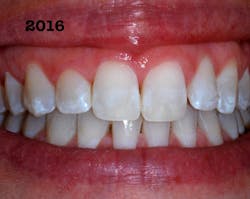 Figure 6: Immediately after treatment, some white dysmineralization remains. Figure 6: Immediately after treatment, some white dysmineralization remains.
