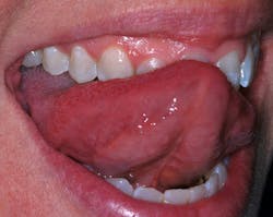 Figure 7: Saliva makes residual stain imperceptible. Figure 7: Saliva makes residual stain imperceptible.