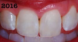 Figure 8: Saliva makes residual stain imperceptible. Figure 8: Saliva makes residual stain imperceptible.