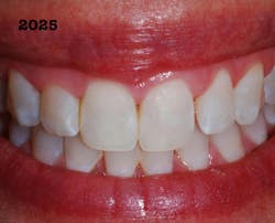 Figure 9: Nine years after successful enamel microabrasion Figure 9: Nine years after successful enamel microabrasion