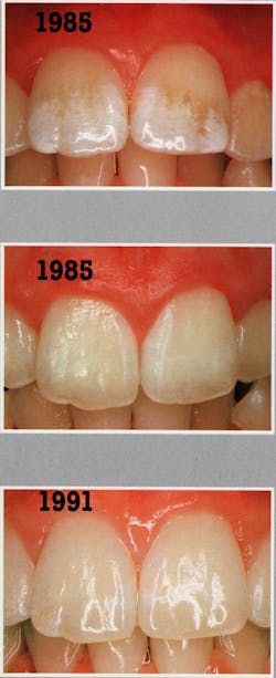 Figure 10: 10-year-old girl with unsightly white dysmineralization stain (page 96 in Croll textbook5) Figure 10: 10-year-old girl with unsightly white dysmineralization stain (page 96 in Croll textbook5)
