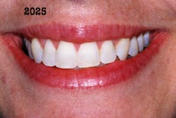 Figure 11: Forty years after enamel microabrasion and tooth bleaching Figure 11: Forty years after enamel microabrasion and tooth bleaching
