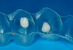 Figure 2: Perfect fill of attachment bubbles using Aligner Flow LC. Figure 2: Perfect fill of attachment bubbles using Aligner Flow LC.