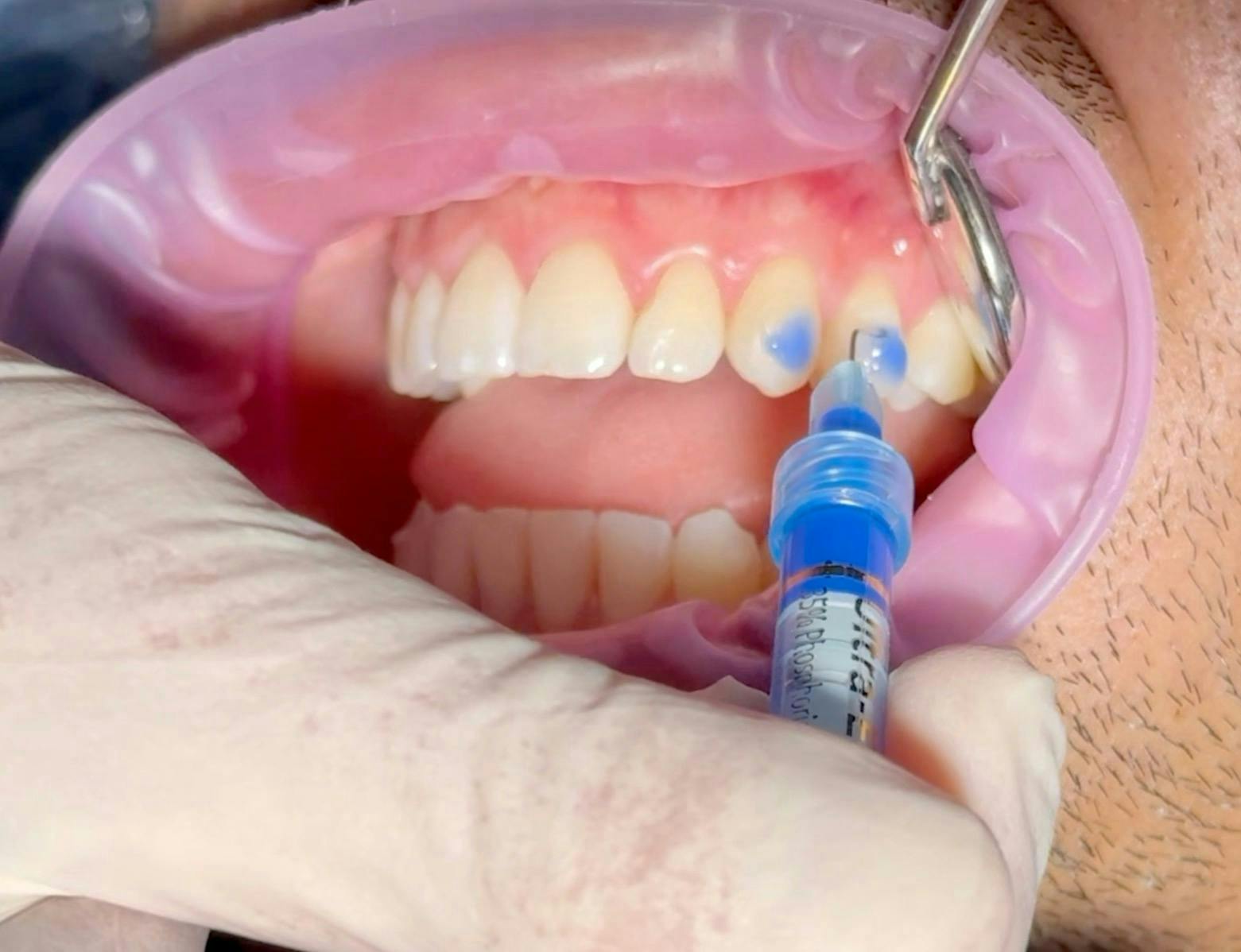Figure 3: Placement of Ultra-Etch. Figure 3: Placement of Ultra-Etch.