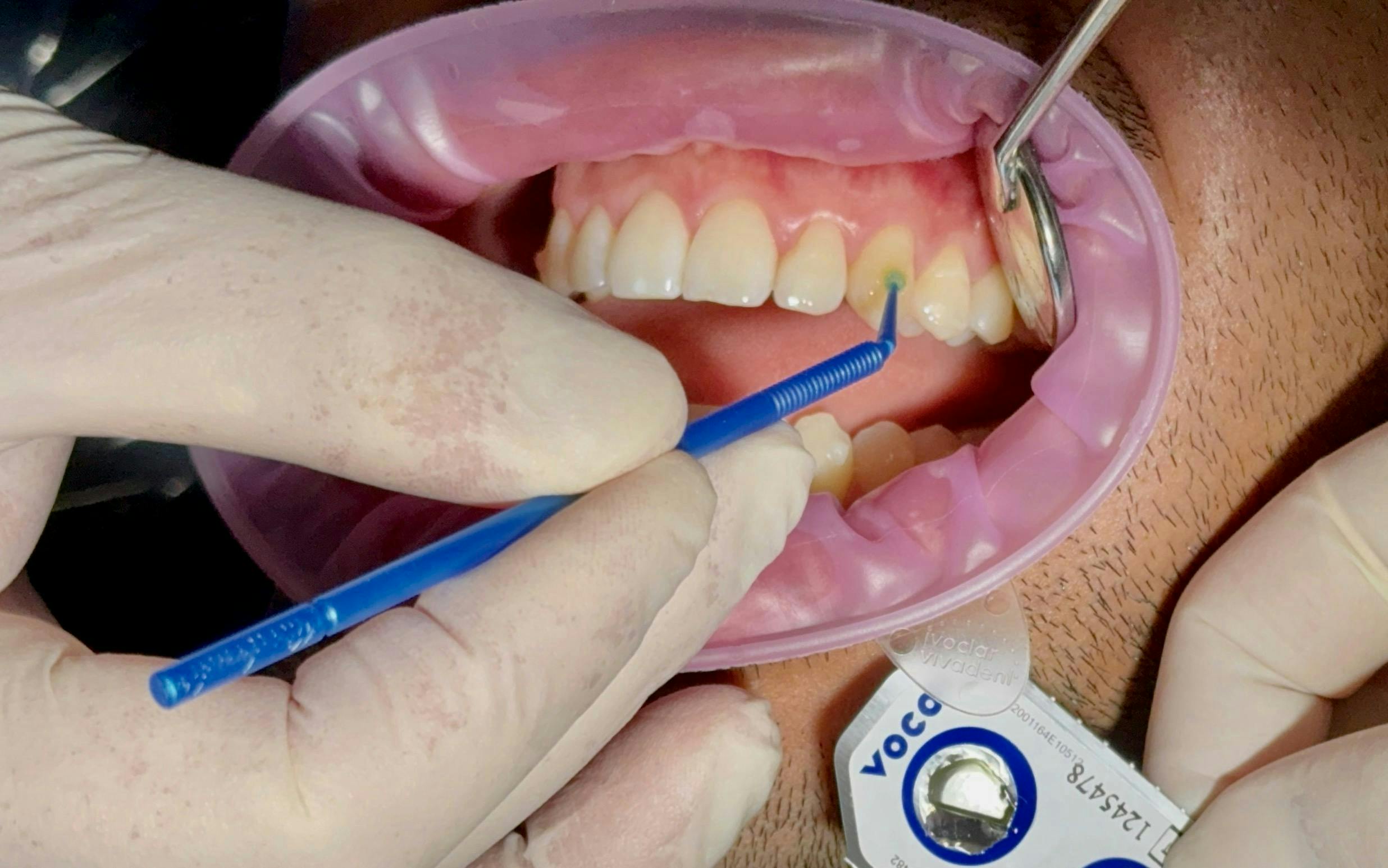 Figure 4: Application of Futurabond U adhesive. Figure 4: Application of Futurabond U adhesive.