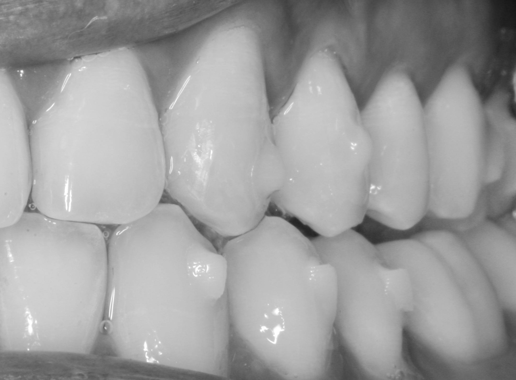 Figure 5: Final attachments in place.