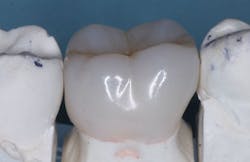 Figure 2: This is a well-made, printed resin crown made from Rodin resin. It has a layer of stain and glaze on it that is yet to have adequate long-term research to predict the longevity of this thin layer. Figure 2: This is a well-made, printed resin crown made from Rodin resin. It has a layer of stain and glaze on it that is yet to have adequate long-term research to predict the longevity of this thin layer.