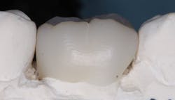 Figure 3: This is a printed Rodin resin crown without the superficial thin layer of resin that could provide short-term color and shine. You can see some unpolished print lines left on this crown that need more finishing and polishing. Figure 3: This is a printed Rodin resin crown without the superficial thin layer of resin that could provide short-term color and shine. You can see some unpolished print lines left on this crown that need more finishing and polishing.