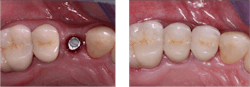 Figure 4: This wear-resistant ceramic crown on the first premolar implant does not move, and the remainder of the teeth do move and intrude during mastication. We need some new iterations of low-wear resin crowns to reduce or eliminate this problem ASAP. Figure 4: This wear-resistant ceramic crown on the first premolar implant does not move, and the remainder of the teeth do move and intrude during mastication. We need some new iterations of low-wear resin crowns to reduce or eliminate this problem ASAP.