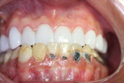 Figure 2: Maxillary arch in temporary Figure 2: Maxillary arch in temporary