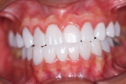 Figure 3: Restored dentition with e.max crowns Figure 3: Restored dentition with e.max crowns