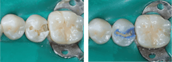 tooth repair tooth repair