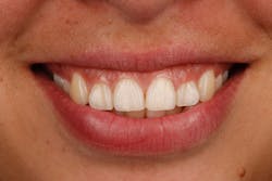 Figure 1: Smile photo and retracted anterior photo can both be used to determine gingival margin position. If the proposed margin is not visible in the smile photo, use the retracted photo for planning. Figure 1: Smile photo and retracted anterior photo can both be used to determine gingival margin position. If the proposed margin is not visible in the smile photo, use the retracted photo for planning.