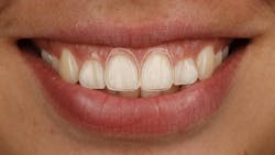 Figure 2: Proposed tooth proportion for central incisors utilizing an 80% height to width ratio Figure 2: Proposed tooth proportion for central incisors utilizing an 80% height to width ratio