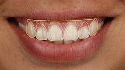 Figure 4: Ideally the gingival margins of the maxillary anterior teeth sit near the inferior border of the upper in a full smile. Figure 4: Ideally the gingival margins of the maxillary anterior teeth sit near the inferior border of the upper in a full smile.