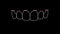 Figure 5: Ideal gingival margin positions with central and canines on the same plane and laterals slightly coronal Figure 5: Ideal gingival margin positions with central and canines on the same plane and laterals slightly coronal