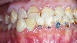 tooth decay caused by sickle cell disease tooth decay caused by sickle cell disease