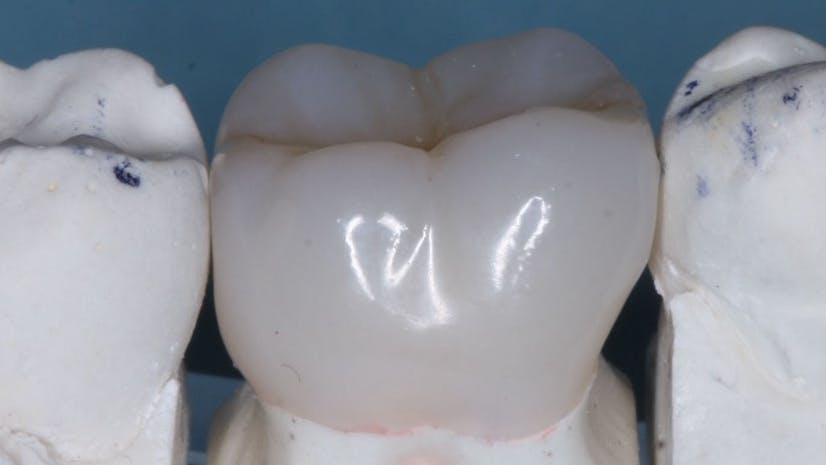 tooth crown made by 3D printing